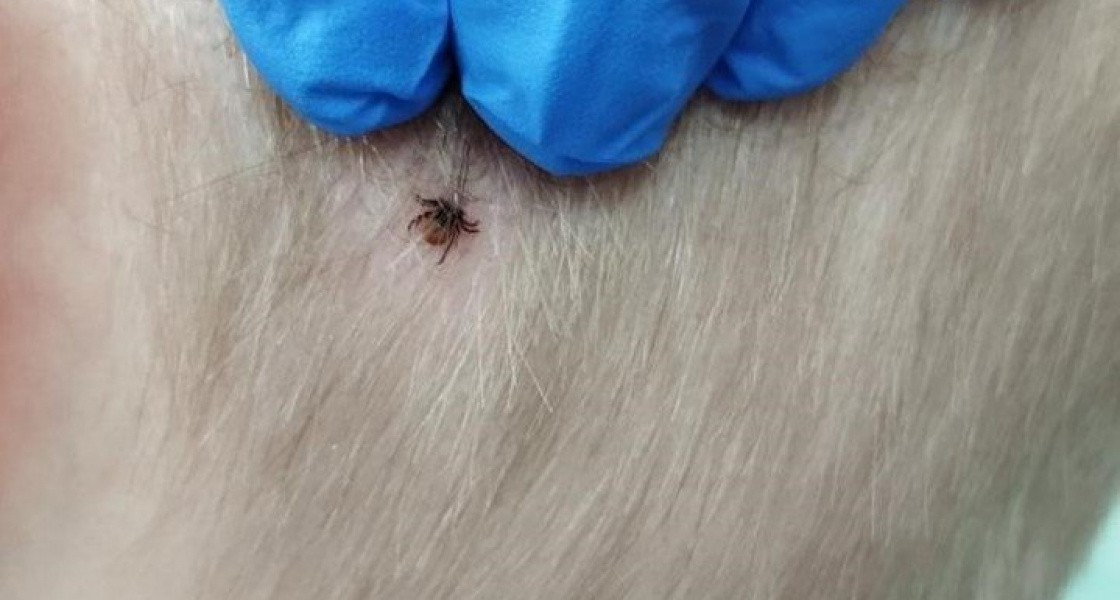В Нижневартовске двоих детей покусали зараженные боррелиозом клещи
